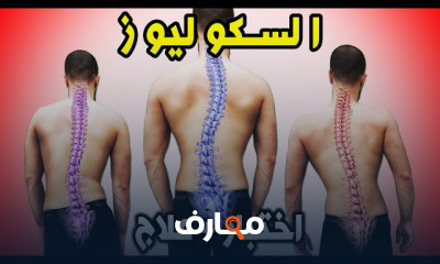 علاج اعوجاج وانحراف العمود