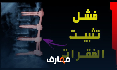 تمارين علاج أعصاب الذراع