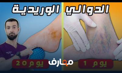 علاج الدوالي وانتفاخ الأرجل