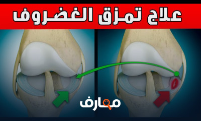 علاج خشونة الركبة