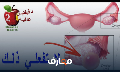 علاج تكيس المبايض