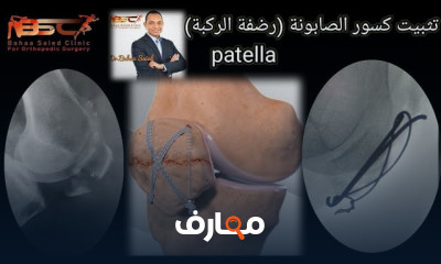علاج قطع الرباط الجانبي للركبة