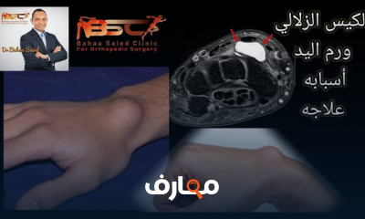 الأكياس الزلالية لمفصل الرسغ