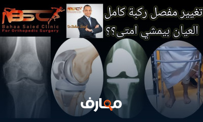 تغيير مفصل ركبة صناعي TKR