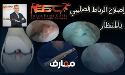 بناء الرباط الصليبي الأمامي