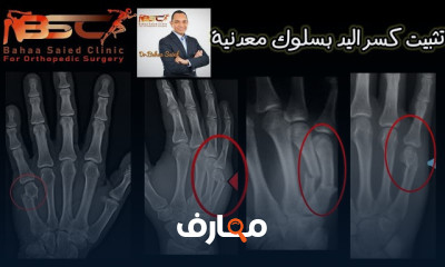إصلاح خلع الكتف المتكرر