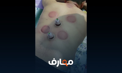 علاج دهون ومشاكل الكبد بالحجامة