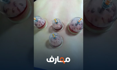 الحجامة لعلاج آلم الكتفين