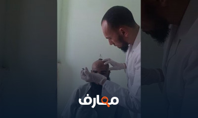 حجامة لعلاج النسيان