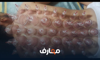 حجامة لعلاج عرق النسا