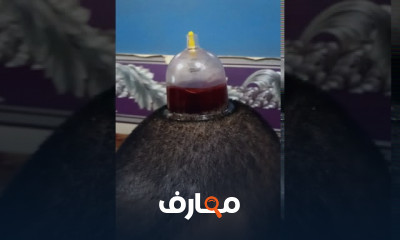 حجامه لعلاج صداع الرأس