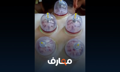 حجامه لعلاج ضعف المناعة