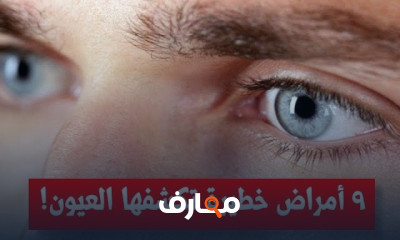 علامات فى العيون تكشف أمراضا