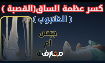 علاج كسر صابونة الركبة