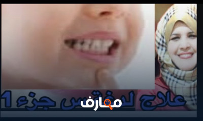 علاج لدغة حرف السين