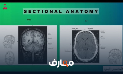 تشريح إشعاعي علي الدماغ