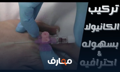 تركيب وازالة الكانيولا بالخطوات